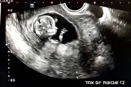 תינוק בן 12 שבועות ברחם